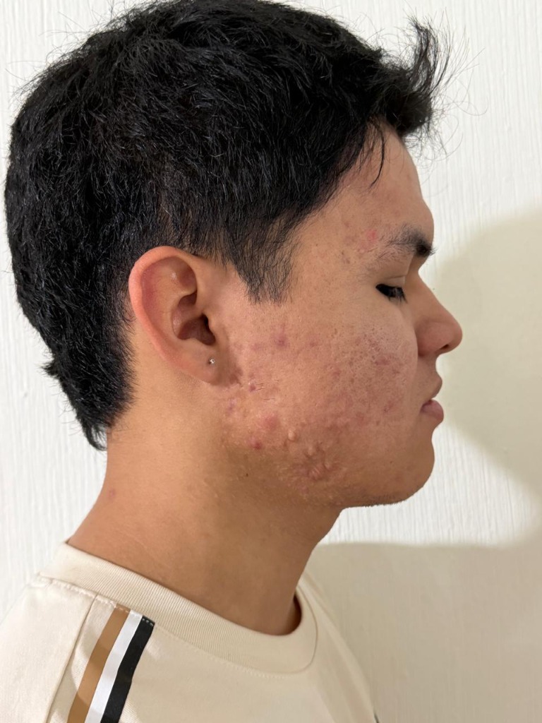 Resultado perfil derecho