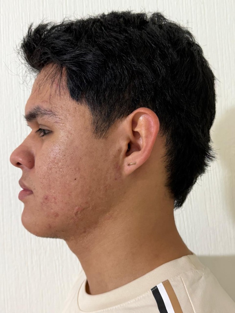 Resultado perfil izquierdo