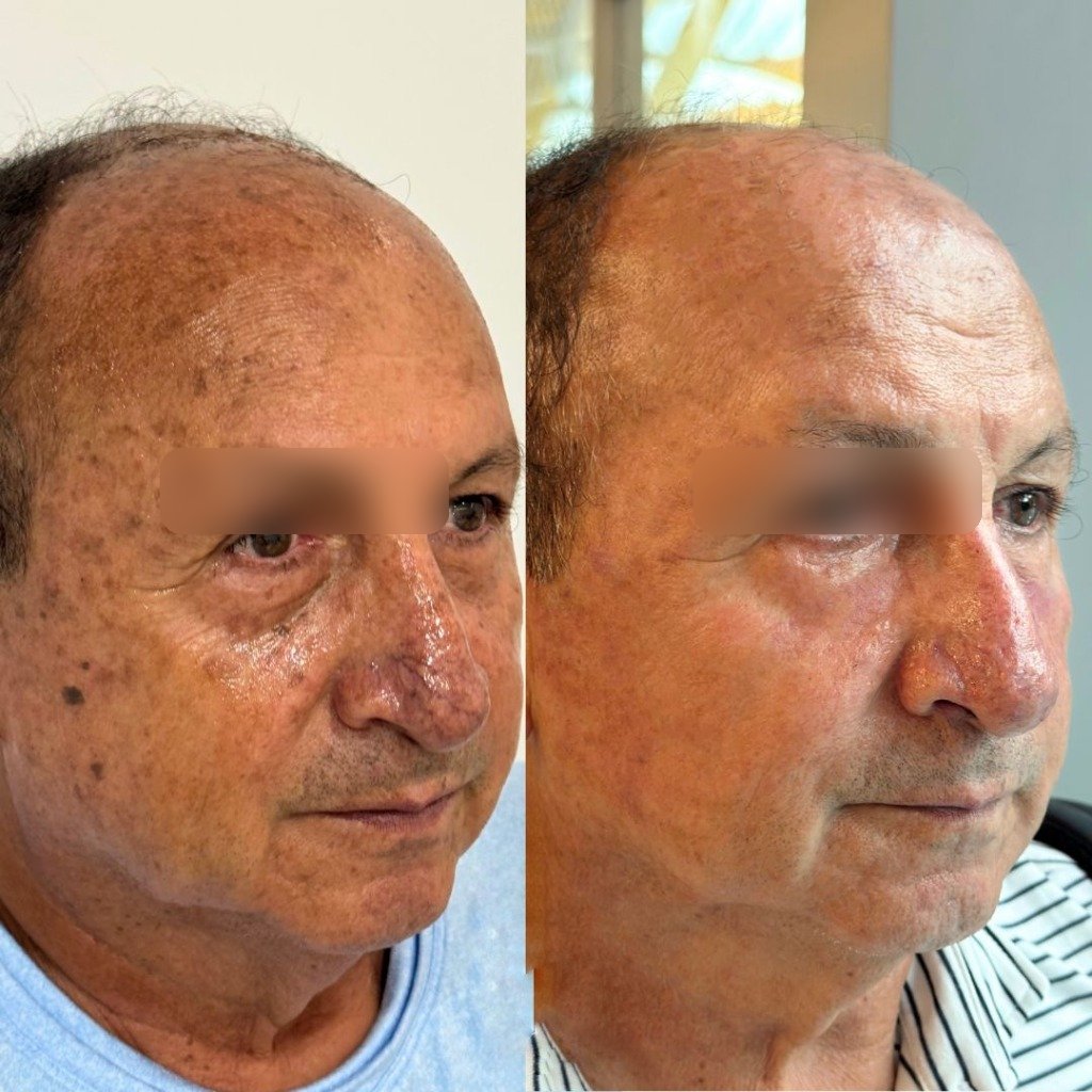 Borrado de manchas faciales peeling antes y despues Chiquimula