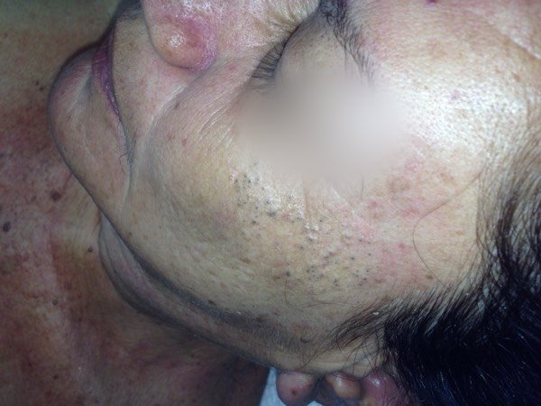 Paciente madura con poros dilatados antes de tratamiento