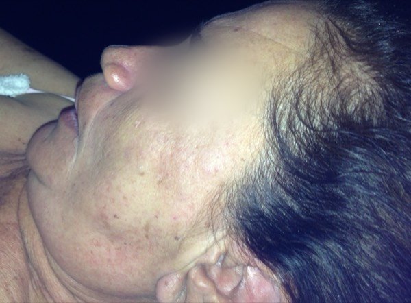 Piel limpia, poros afinados - Resultado rostro